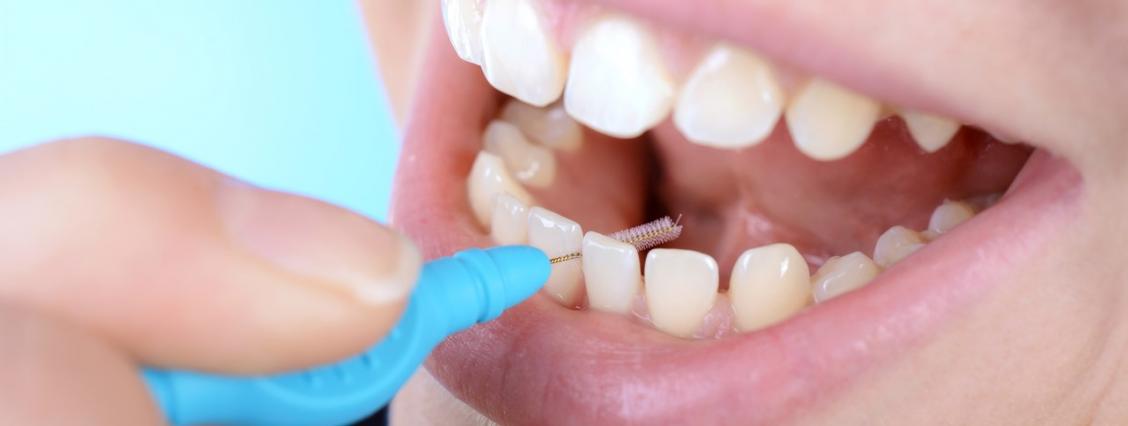 Interdentalraumhygiene in verschiedenen Altersstufen