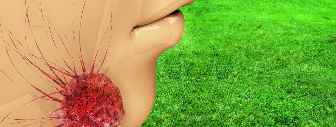 Mundhöhlenkrebs Gesicht gezeichnet