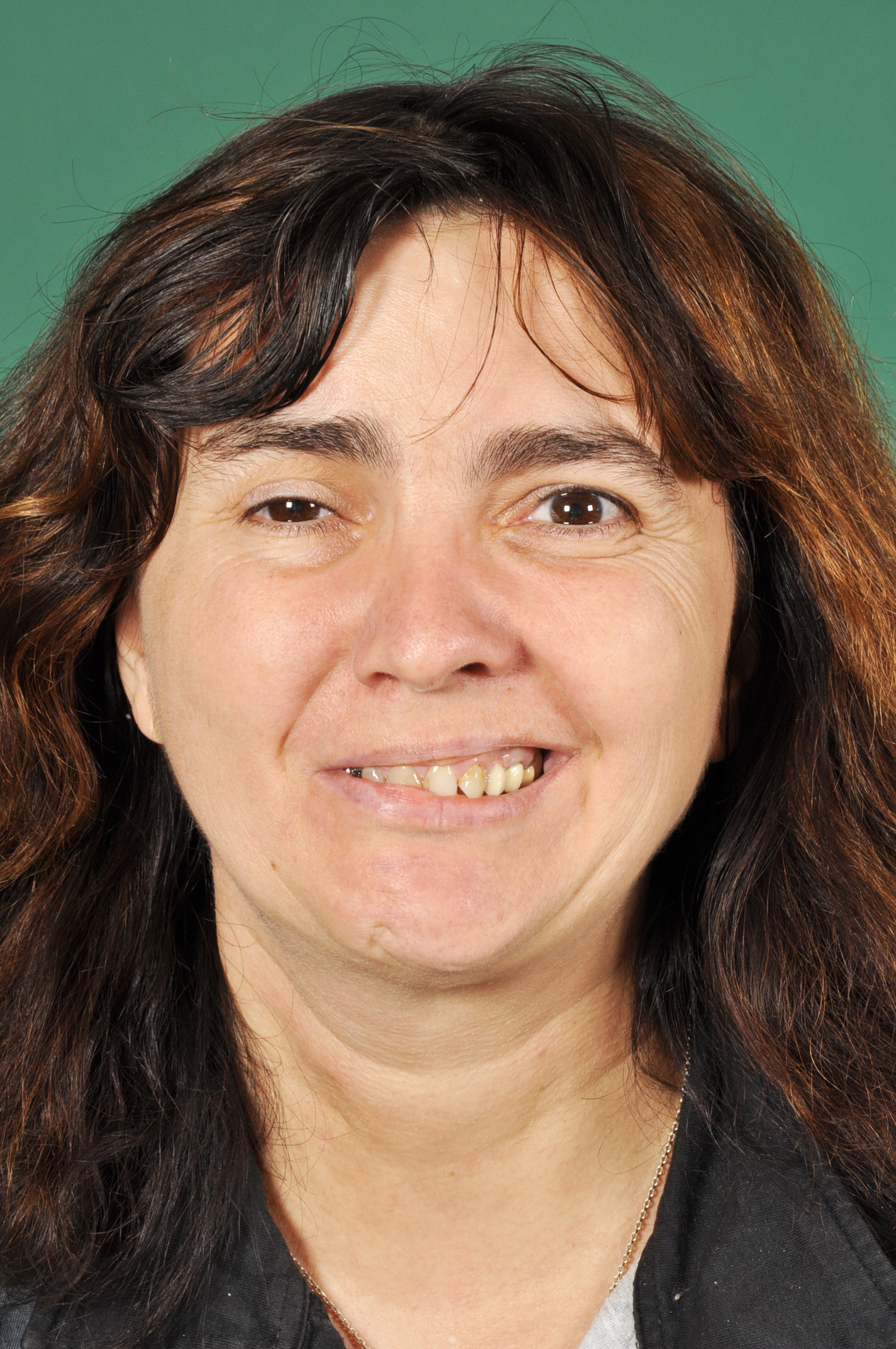 Abb. 1a: Zähnezeigen – kein Bukkalkorridor auf der paretischen Seite