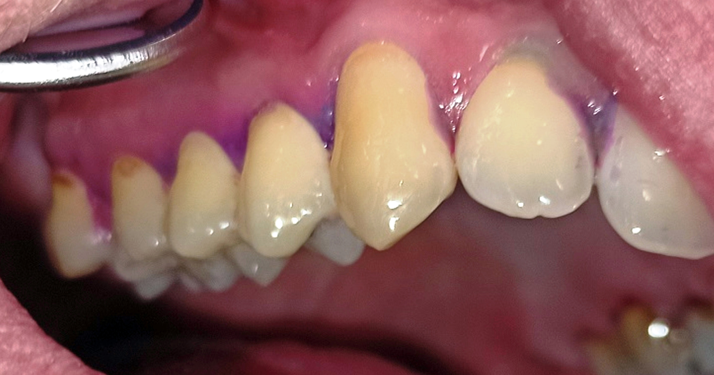 Abb. 2a: Nicht paretische Mundhälfte (1. Quadrant)