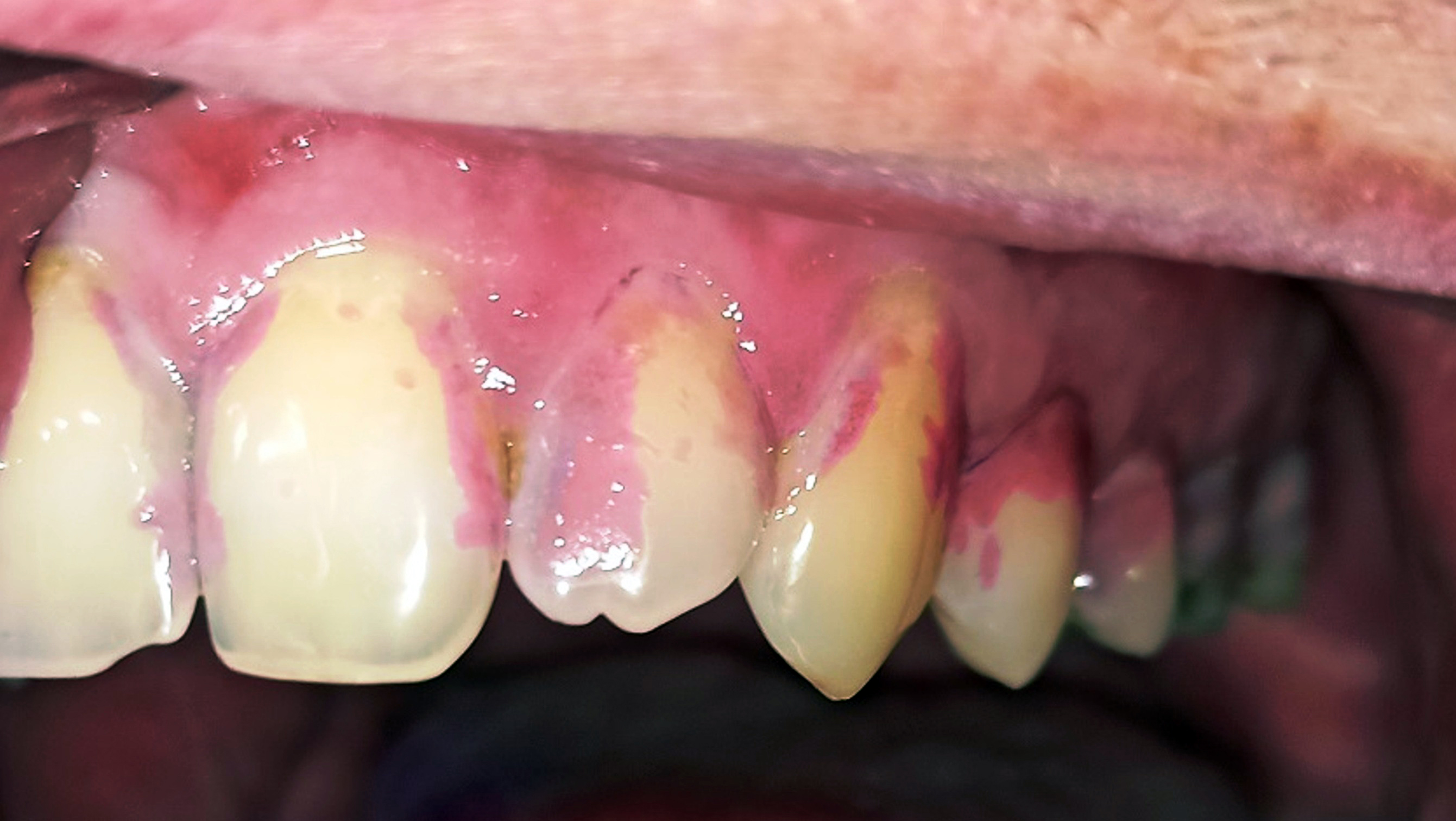 Abb. 2b: Paretische Mundhälfte (2. Quadrant)