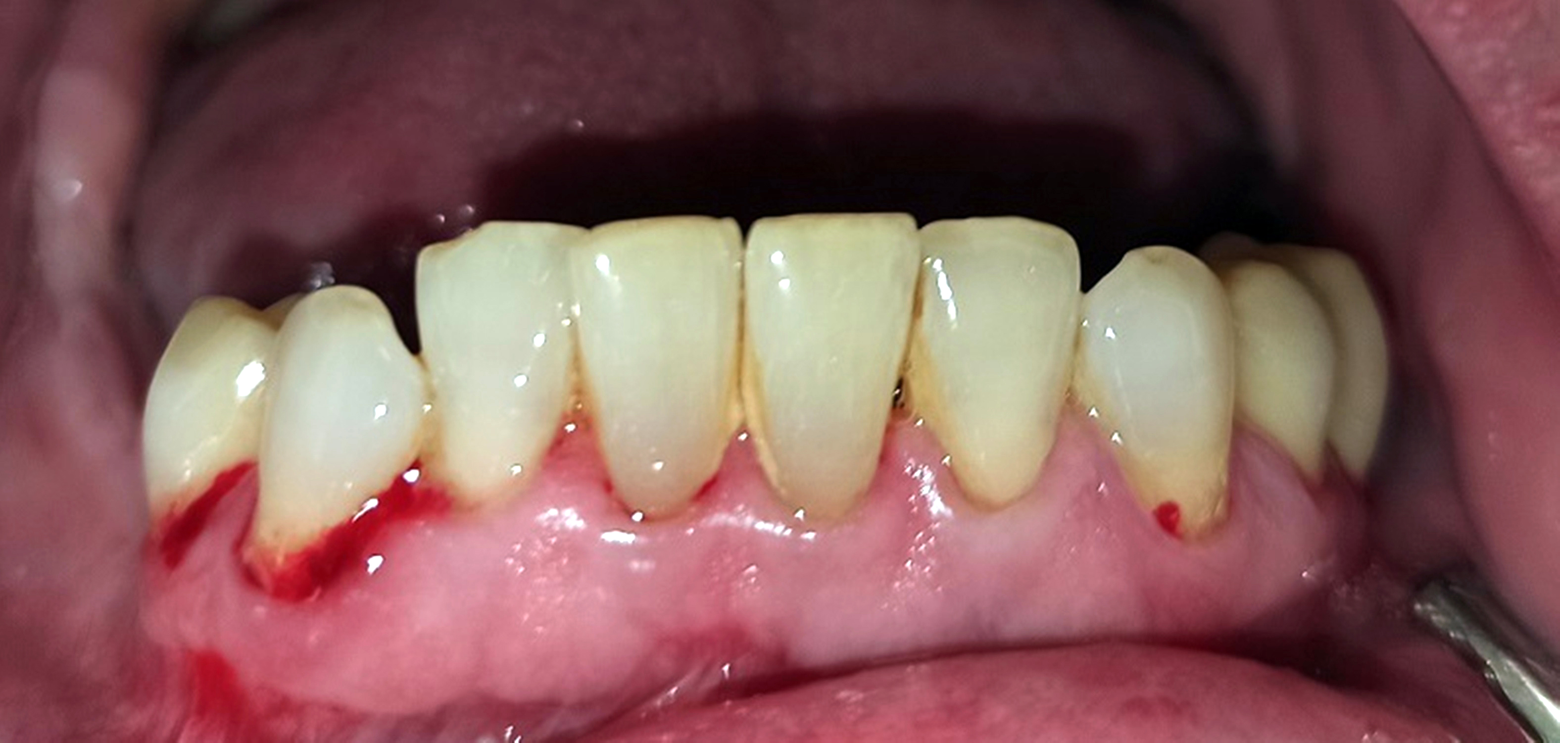 Abb. 3: Vergleich der paretischen und nicht paretischen Mundhälfte in Bezug auf die sulkuläre Blutungstendenz