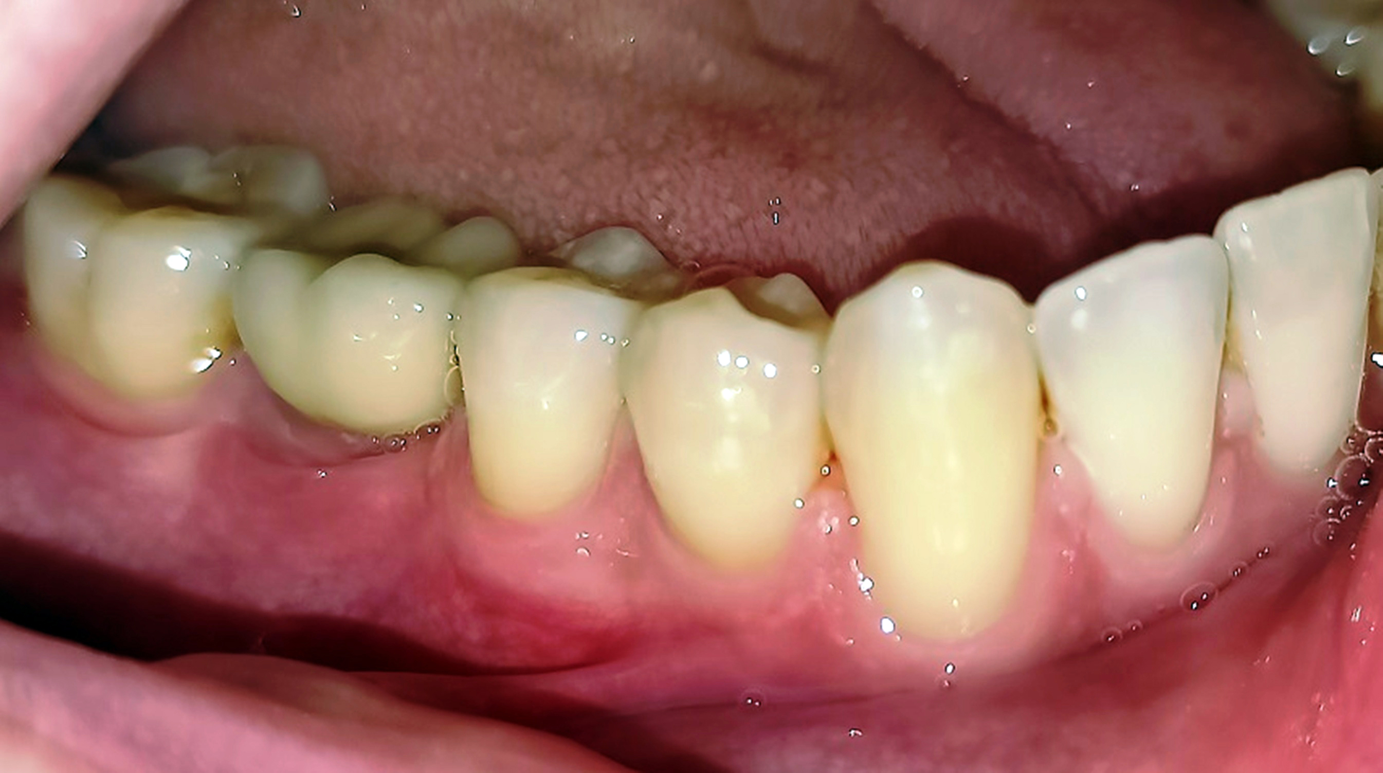 Abb. 4a: Nicht paretische Seite (4. Quadrant)