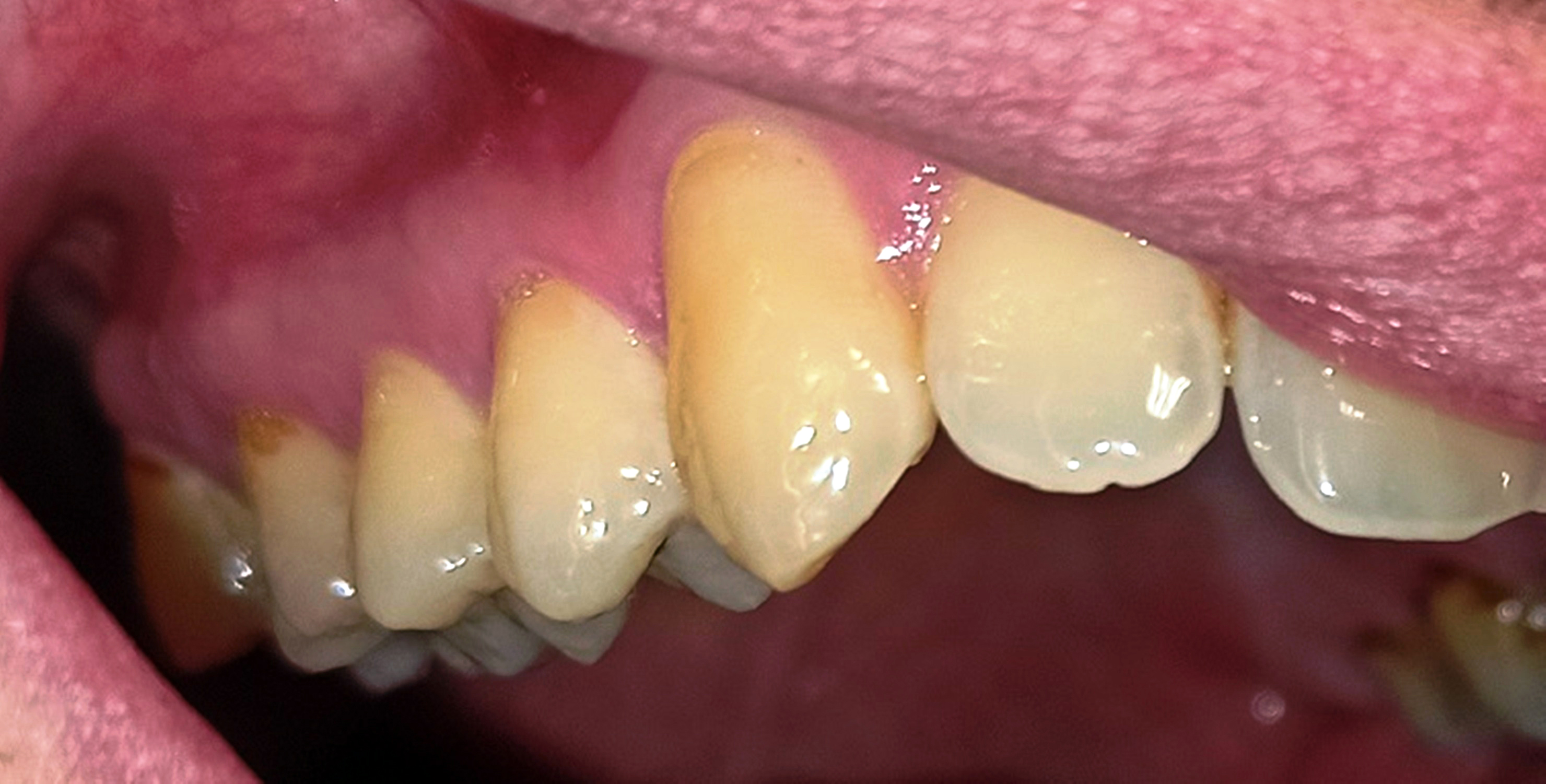 Abb. 5a: Nicht paretische Seite – kariesfrei (1. Quadrant)