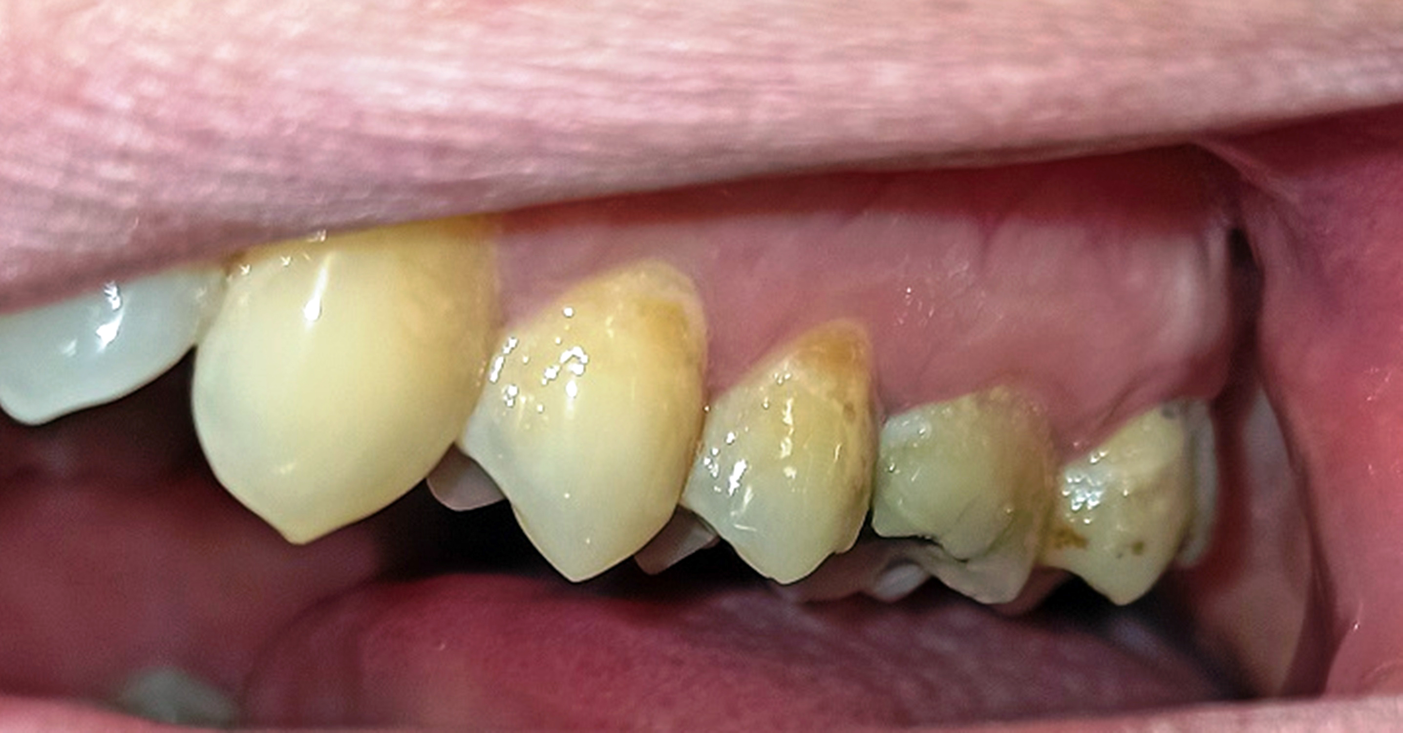 Abb. 5b: Paretische Seite – multiple kariöse Läsionen (2. Quadrant)