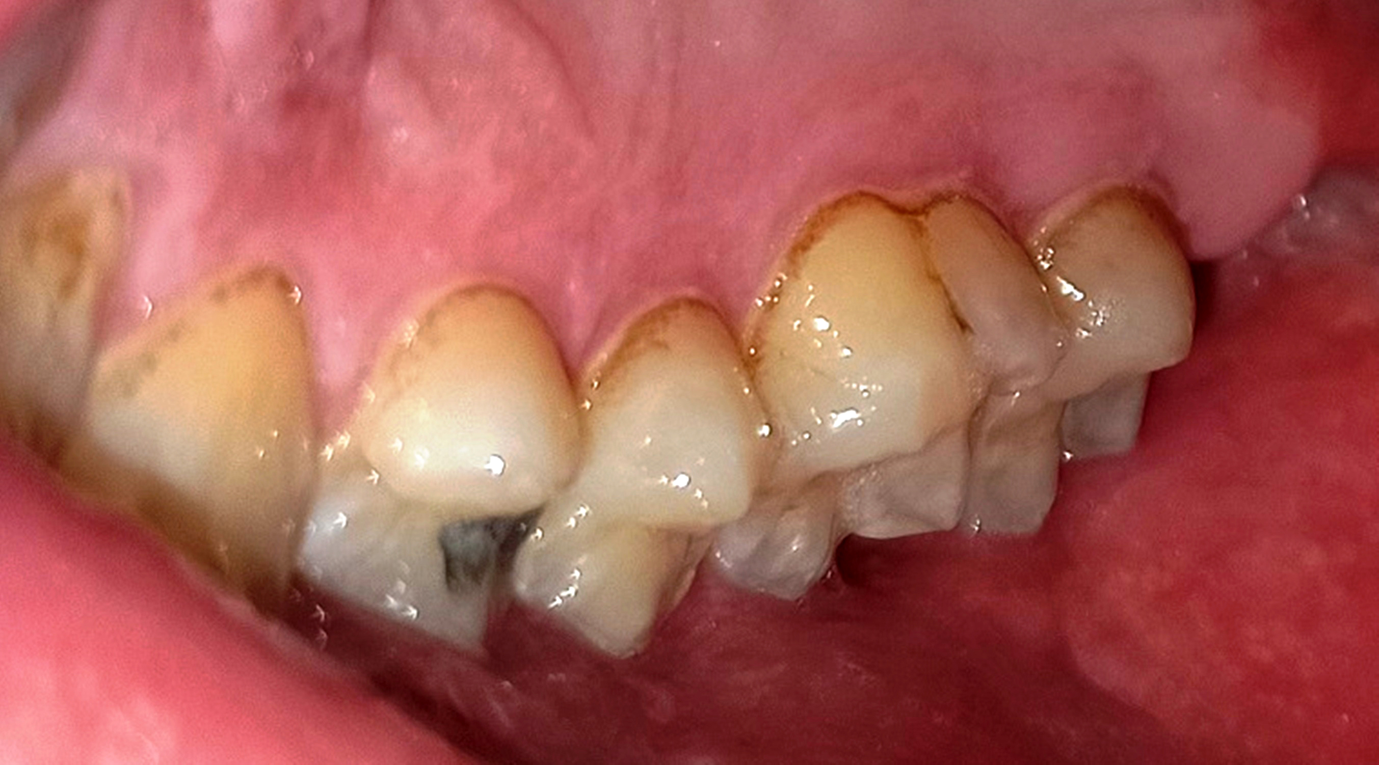 Abb. 6a: Nicht paretische Seite – Zahnstein (1. Quadrant)