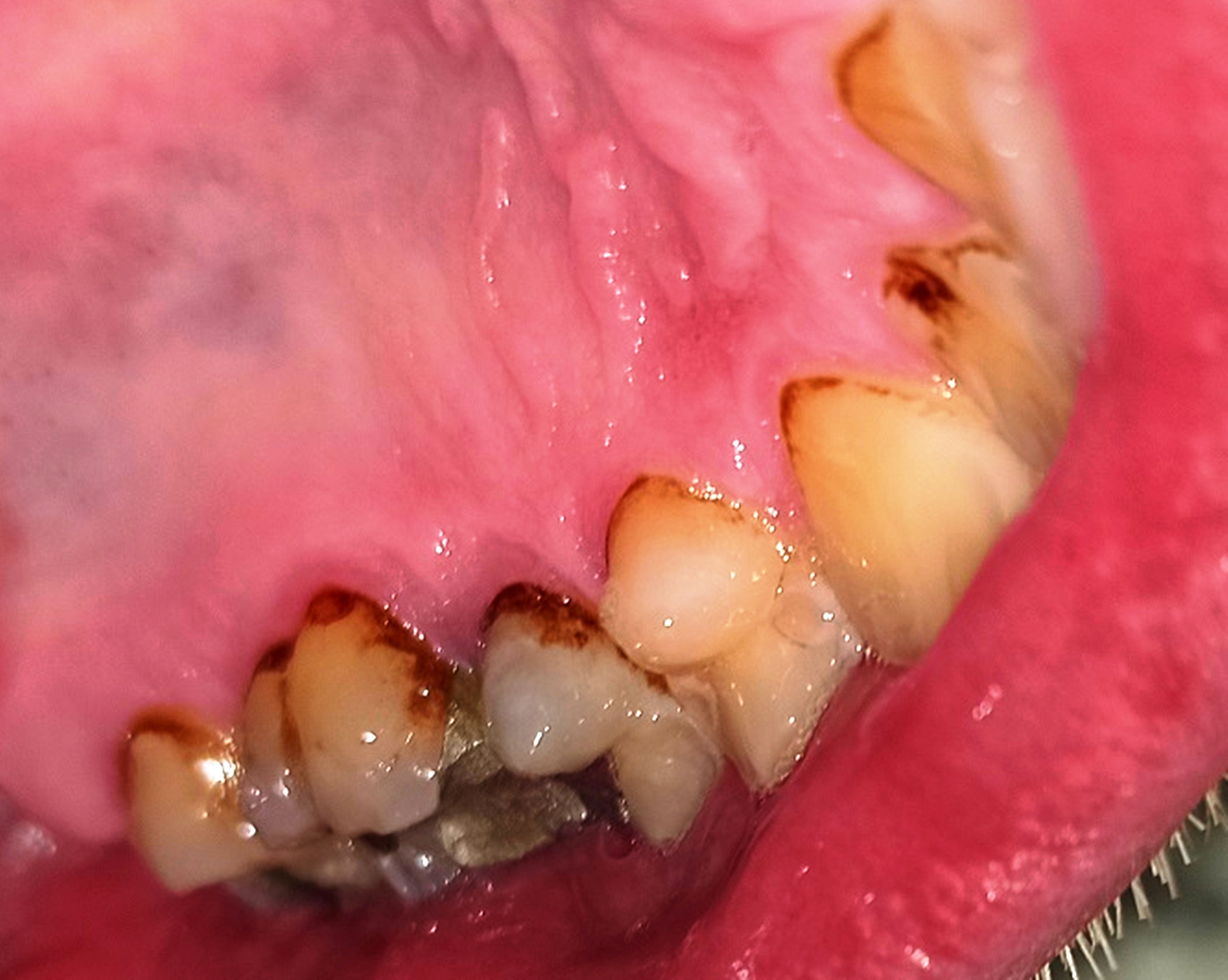 Abb. 6b: Paretische Seite – Zahnsteinablagerungen (2. Quadrant)