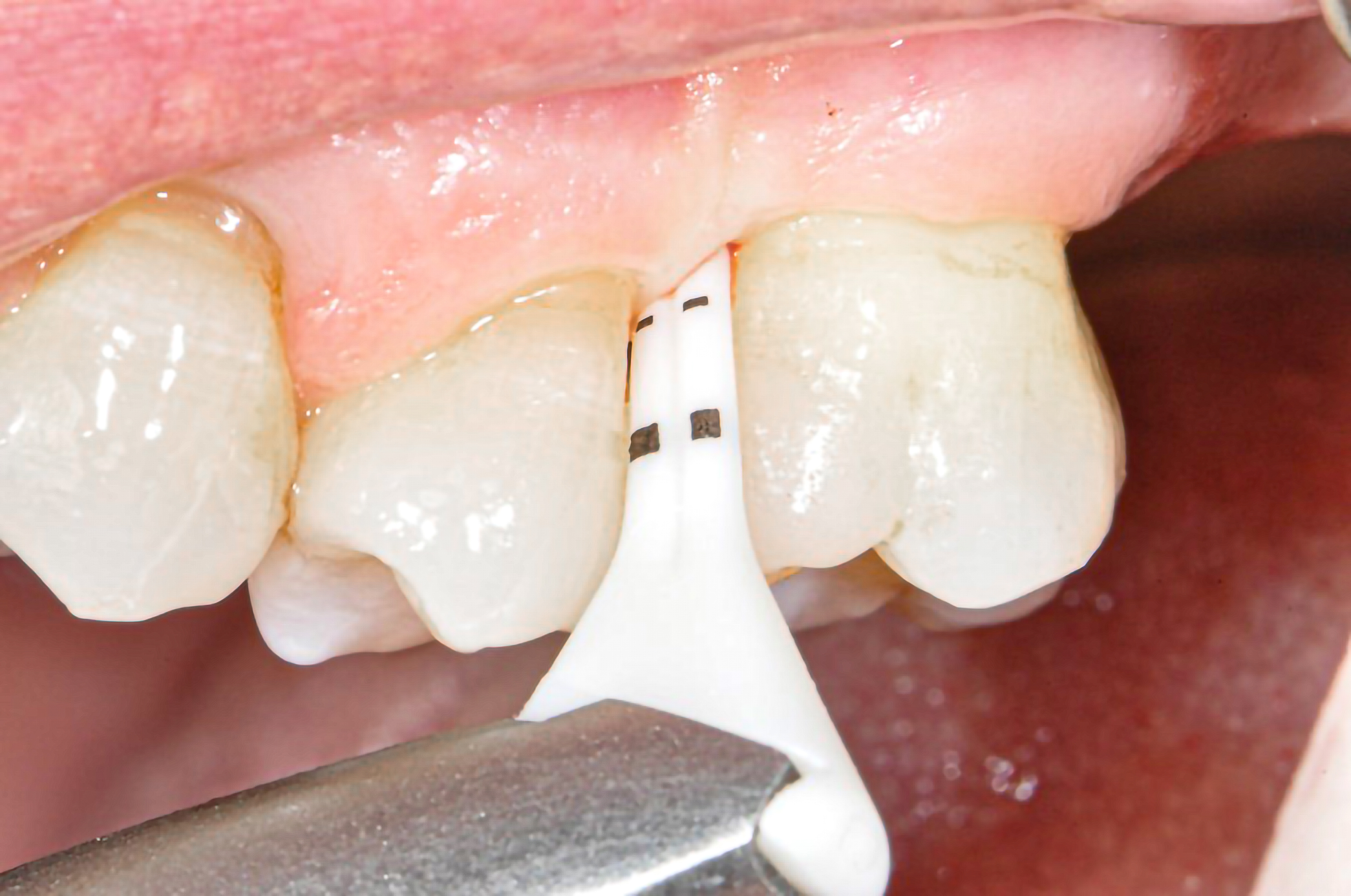 Abb. 4: Zur Biofilm-Entfernung in tieferen Taschen um Zähne und Implantate können spezielle Handstücke und Instrumente verwendet werden.