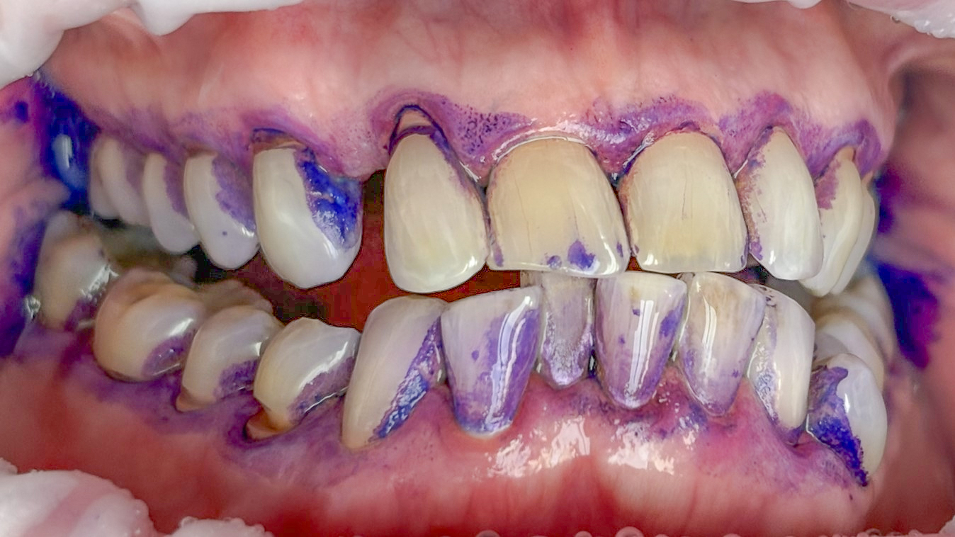 Abb. 7a und b: Klinischer Fall Nr. 1 – Recall, GBT-Schritte.