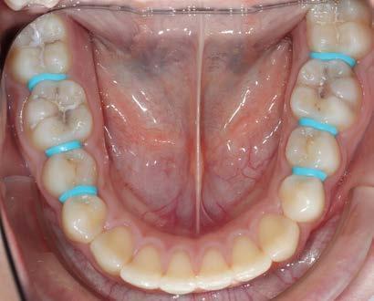 Abb. 1a: Klinische Fotos nach dem Einsetzen der kieferorthopädischen Separiergummis approximal