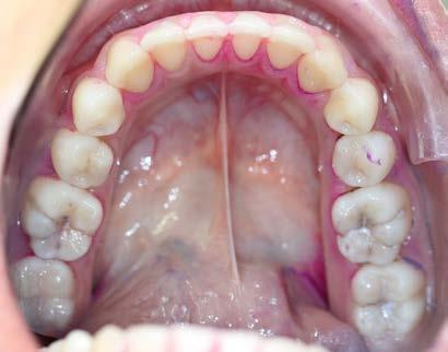 Abb. 1c: Klinisches Foto in der Nachuntersuchung knapp 1,5 Jahre nach AgF-Applikation