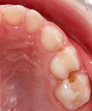 Abb. 2a: Kavitierte kariöse Läsionen an Milchzähnen vor der Applikation von SDF