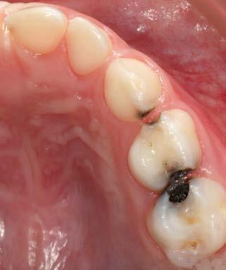 Abb. 2b: Okklusale Ansicht der Milchmolaren einen Monat nach SDF-Applikation