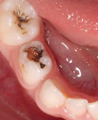 Abb. 3b: Restaurative Therapie mit SMART-Techniken