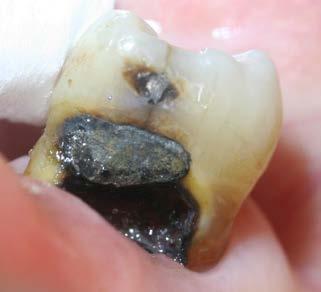 Abb. 4a: Wurzelkaries vor Applikation von SDF