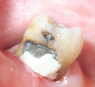 Abb. 4b: Kariesinaktivierung unmittelbar nach Applikation von SDF