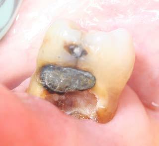 Abb. 4c: Provisorische Füllung mit konventionellem Glasionomerzement