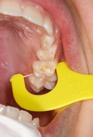 Abb. 3: Darstellung eines 4-jährigen Kindes mit lückigem Milchzahngebiss