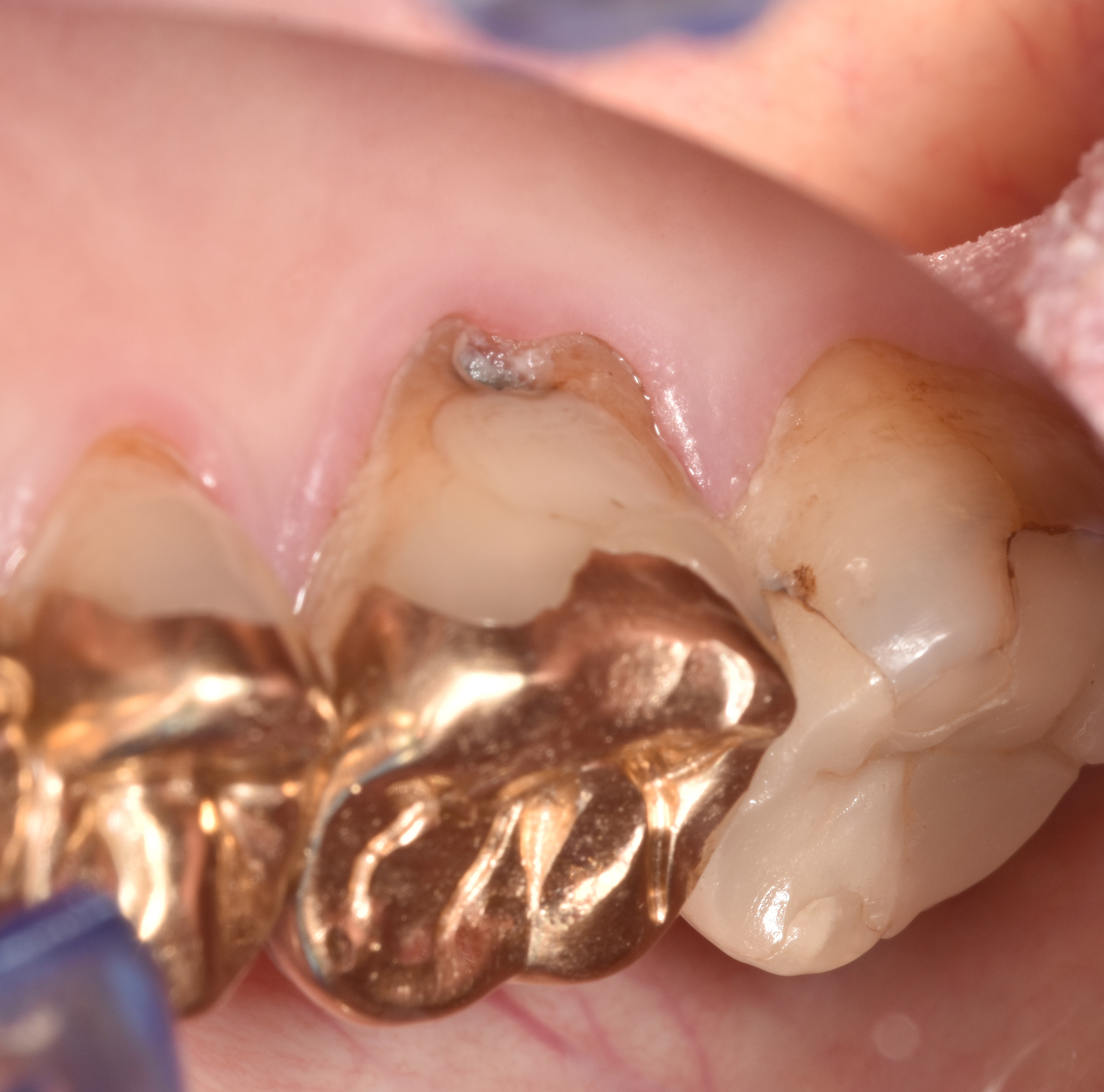 Abb. 1f: Zahn 16 mit Wurzelkaries