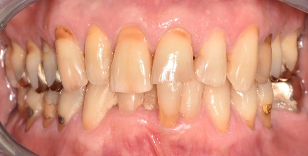 Abbildung 1a: Ansicht von frontal in habitueller Okklusion