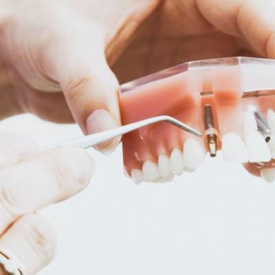 Gebissmodell mit Implantat, von Händen gehalten