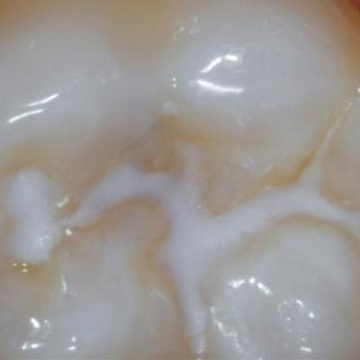 Ein Zahn mit Fissurenversiegelung