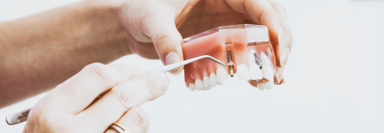 Gebissmodell mit Implantat, von Händen gehalten